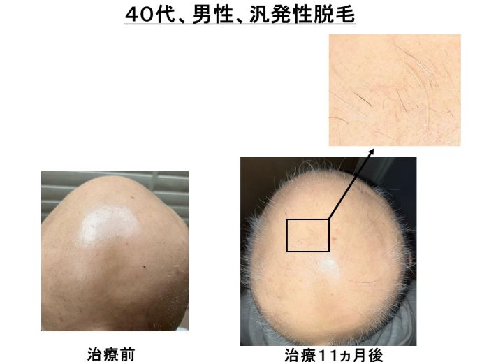 手術用照明器 SKYLUX CRYSTAL SERIES CR04B ZB 山田医療照明